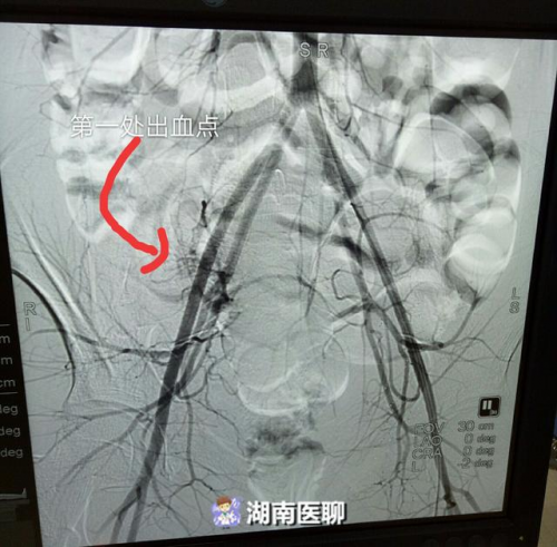 股动脉介入后有硬块