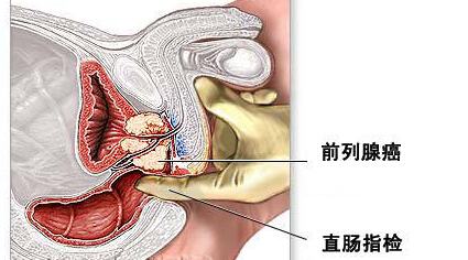 下肢骨疼或是前列腺癌作怪