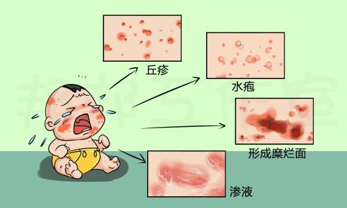 慢性湿疹症状图片