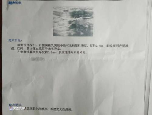 宝宝先天斜颈,出生半年内治疗最佳!赶紧检查下宝宝脖子