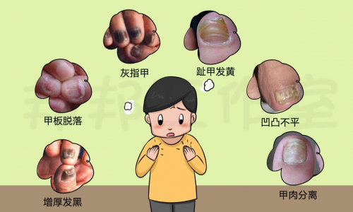 如何治疗脚气和灰指甲