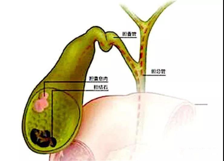 3cm卡在胆囊径口,且偶尔出现胆囊炎,必须手术