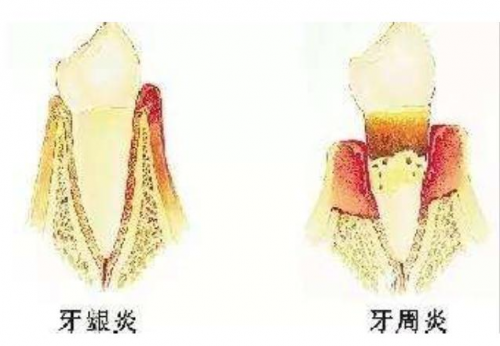 中间类杆菌,螺旋体等,使牙龈的炎症加重并扩延,导致牙周袋形成和牙槽