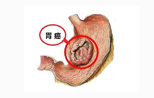 胃癌和胃溃疡该如何鉴别,该怎么治疗?