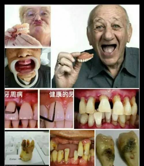 牙周病早期症状一般表现为 牙龈炎症和 出血,后期多种因素造成牙周袋