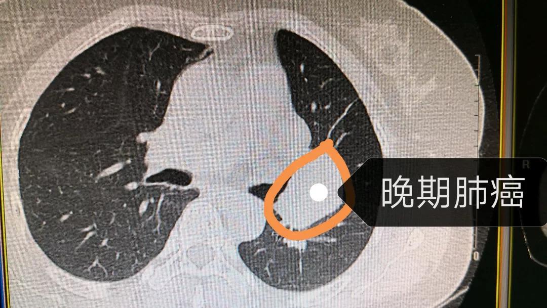 一照ct肺有小结节,我会是肺癌吗?