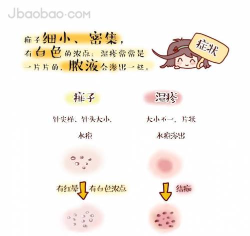 痱子细小,密集,有白色的浓点;湿疹常常是一片片的,脓液会渗出一些.