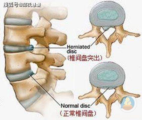 腰椎间盘突出是什么原因引起的 邱氏悬壶 平安健康 腰椎间盘突出是什么原因引起的 邱氏悬壶 平安健康