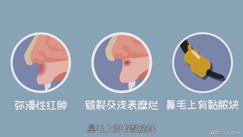 那个抠鼻屎可能会得的病 鼻前庭炎到底是啥 平安好医生