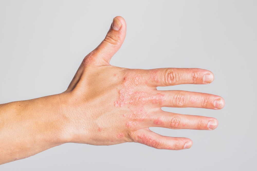 频率高,远离洗涤剂才有希望常见病手湿疹洗涤剂湿疹易松柏服搽洗剪消