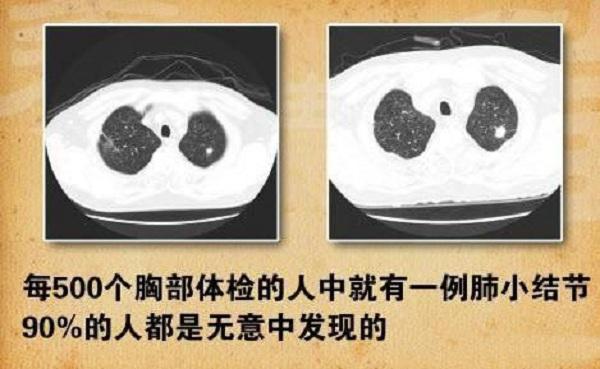 投保前不告知肺结节 肺部结节影响买保险吗