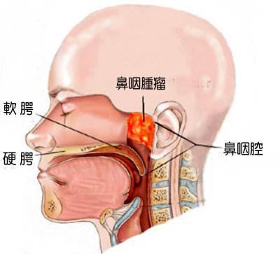 首大刘玉梅 从鼻咽炎到鼻咽癌 比你想象的快 平安健康 首大刘玉梅 从鼻咽炎到鼻咽癌 比你想象的快 平安健康