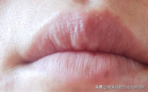 激素依赖性皮炎研究院 春天嘴唇干裂起皮 不舔不撕还能怎么办 平安好医生 激素依赖性皮炎研究院 春天嘴唇干裂起皮 不舔不撕还能怎么办 平安好医生