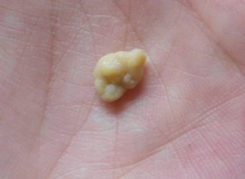 嘴巴里的“小米粒”，是身体发出的“求救信号”，多数人