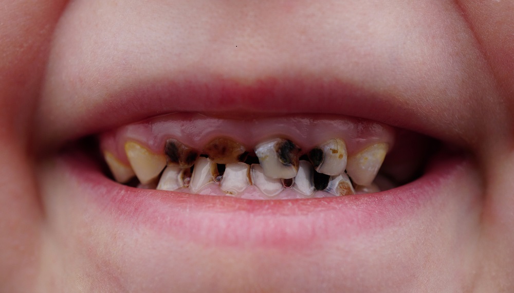 儿童牙齿黑斑怎么回事,龋齿都集中在哪个年龄段
