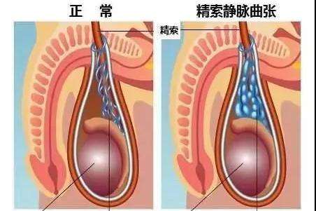 精索静脉曲张是怎么回事?