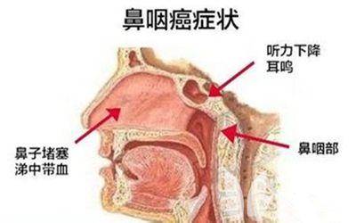 首大刘玉梅 从鼻咽炎到鼻咽癌 比你想象的快 平安健康 首大刘玉梅 从鼻咽炎到鼻咽癌 比你想象的快 平安健康